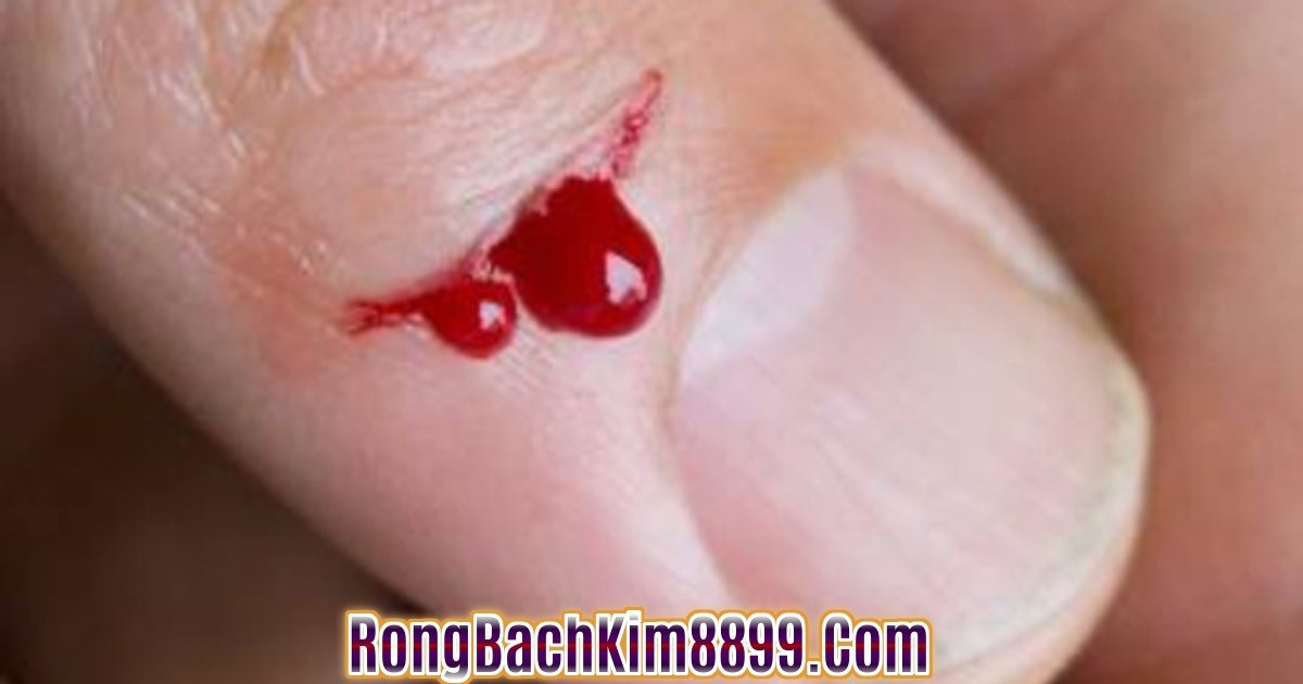 Mơ thấy đứt tay của mình chảy máu