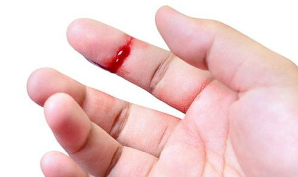Nằm mơ thấy đứt tay có ý nghĩa gì